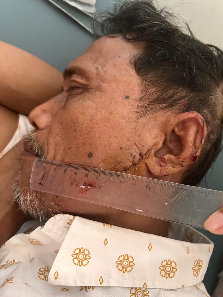 Kasus Penganiayaan Berat Yang Dialami Aca di Bukit Lawang, Oleh Diduga Bandar Narkoba HBB Hingga Kini Belum Berujung